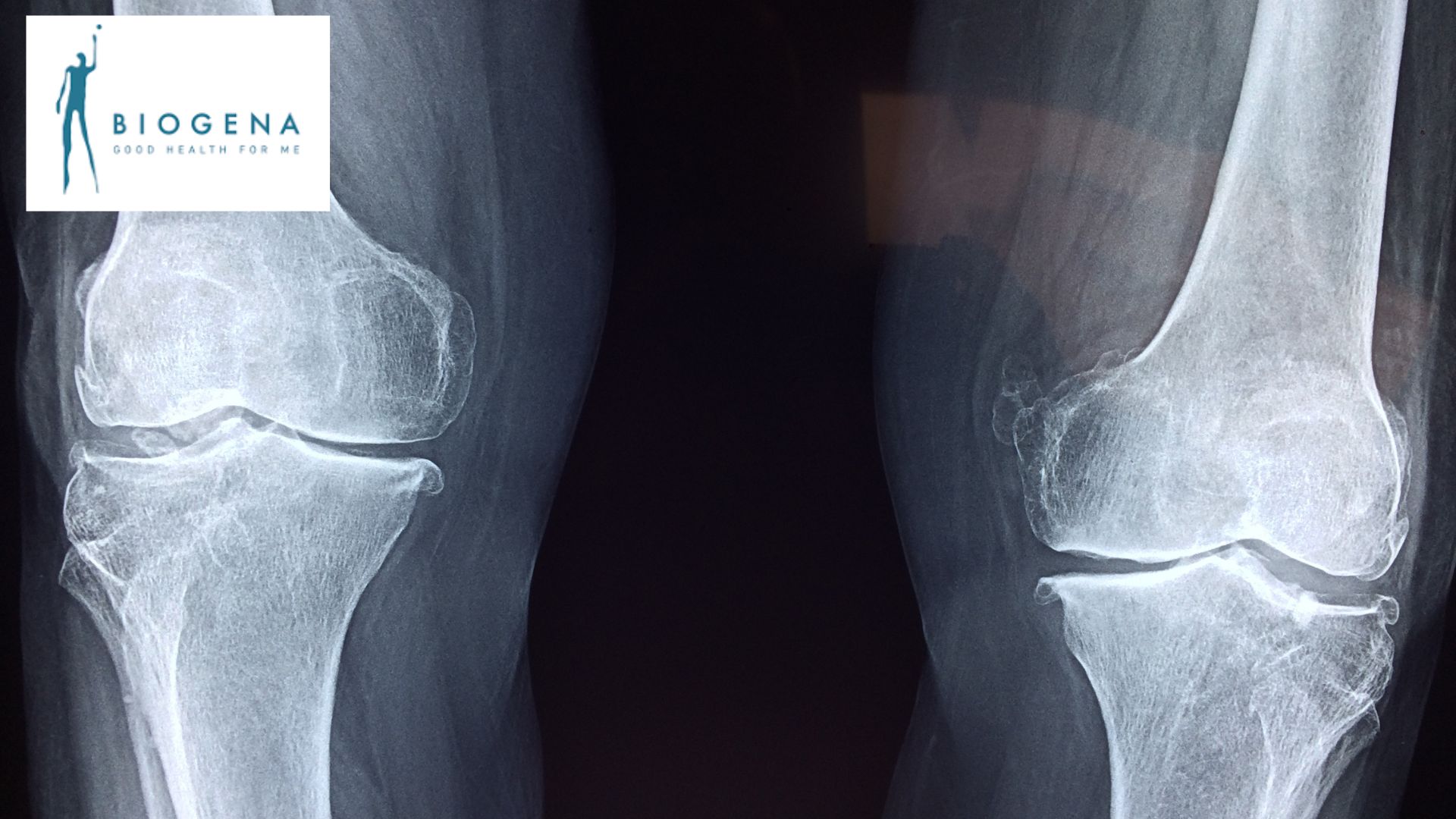 Bild zeigt Knochenstruktur